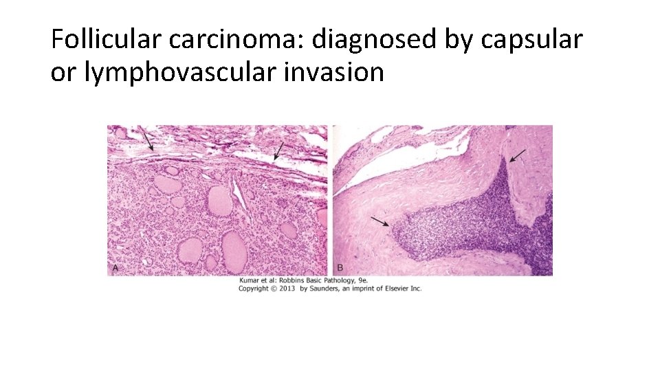 Follicular carcinoma: diagnosed by capsular or lymphovascular invasion 