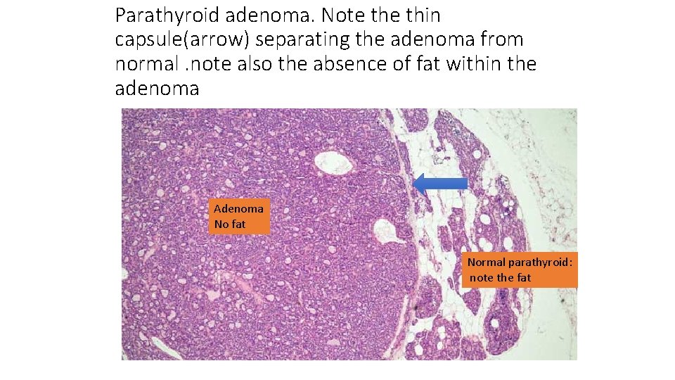 Parathyroid adenoma. Note thin capsule(arrow) separating the adenoma from normal. note also the absence