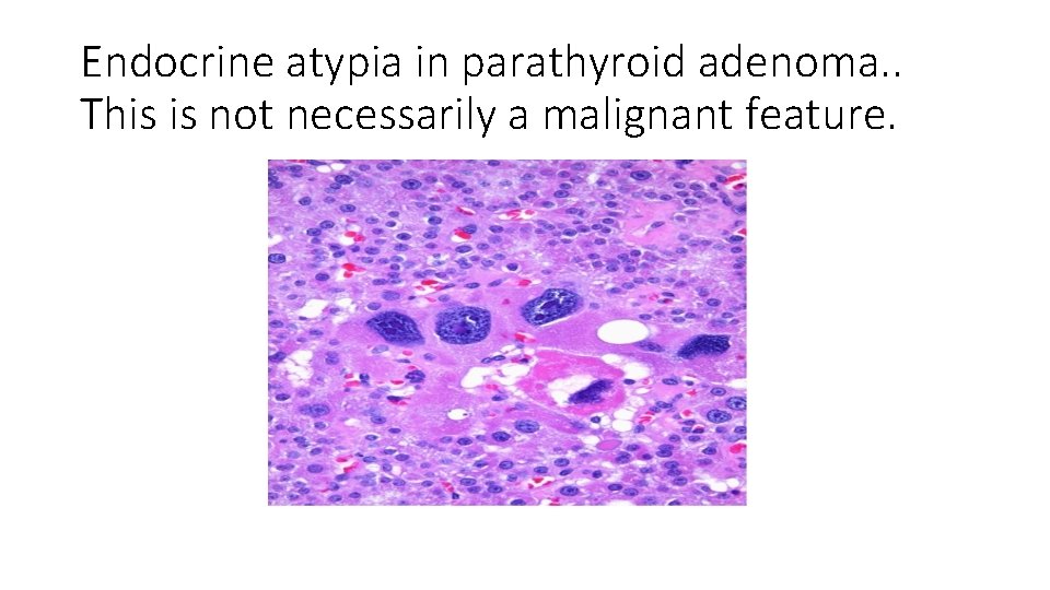 Endocrine atypia in parathyroid adenoma. . This is not necessarily a malignant feature. 