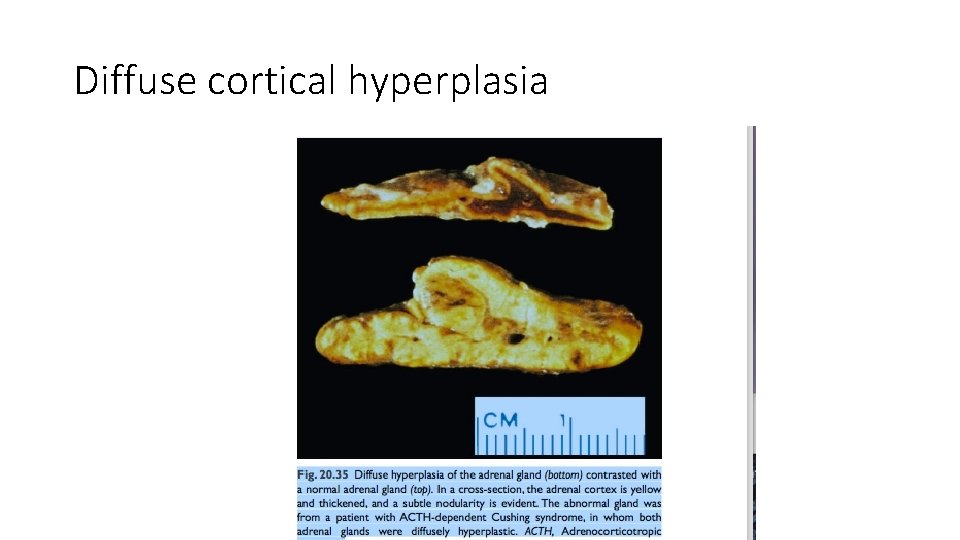 Diffuse cortical hyperplasia 