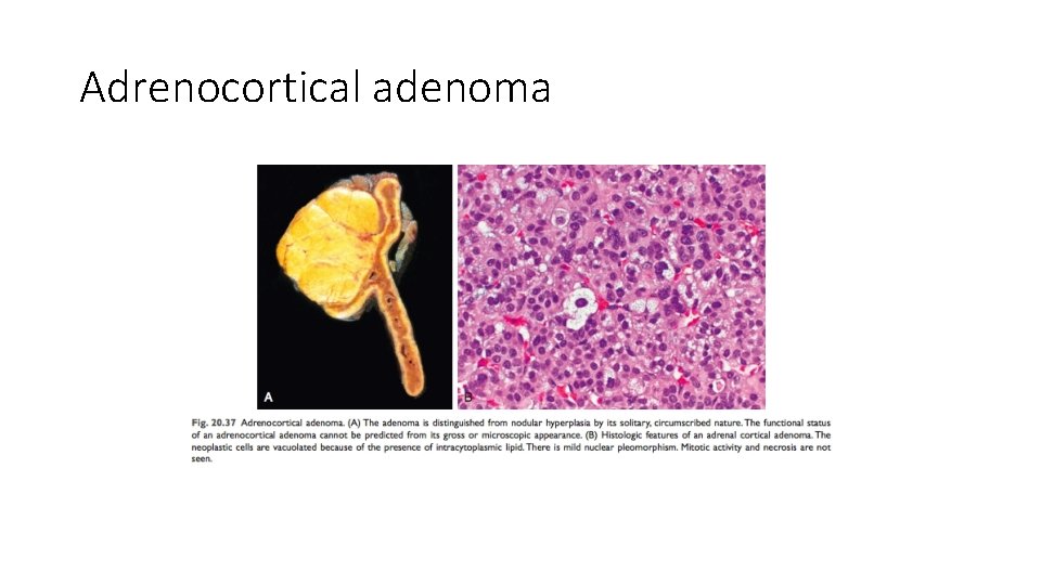 Adrenocortical adenoma 