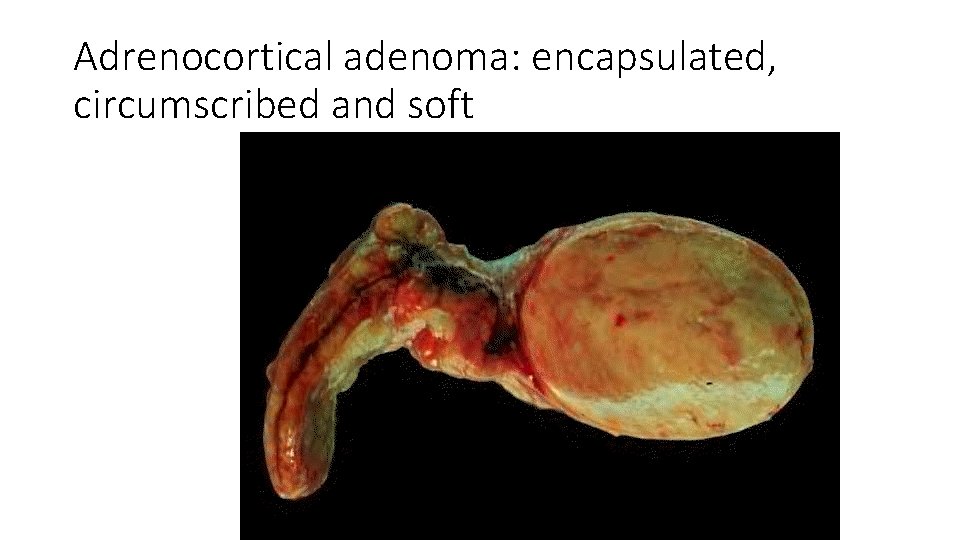 Adrenocortical adenoma: encapsulated, circumscribed and soft 