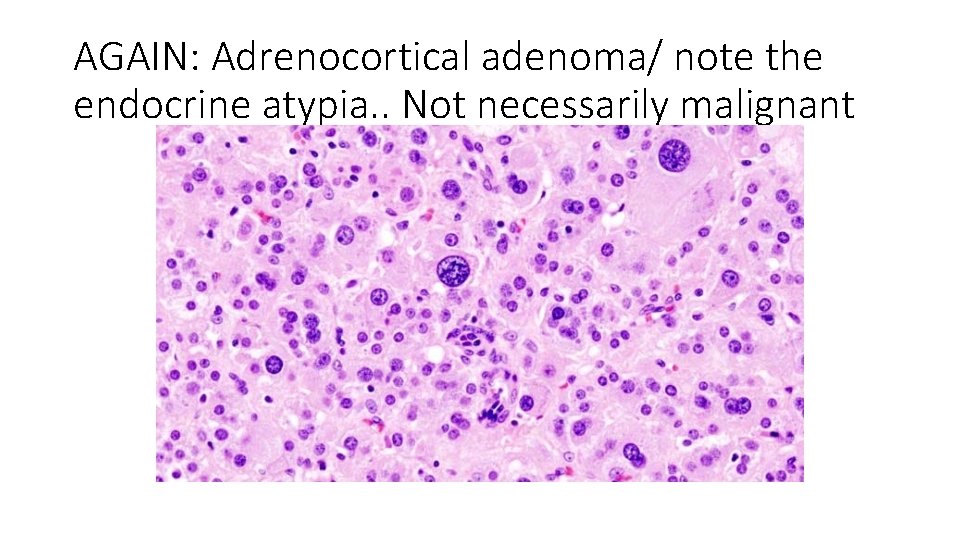 AGAIN: Adrenocortical adenoma/ note the endocrine atypia. . Not necessarily malignant 