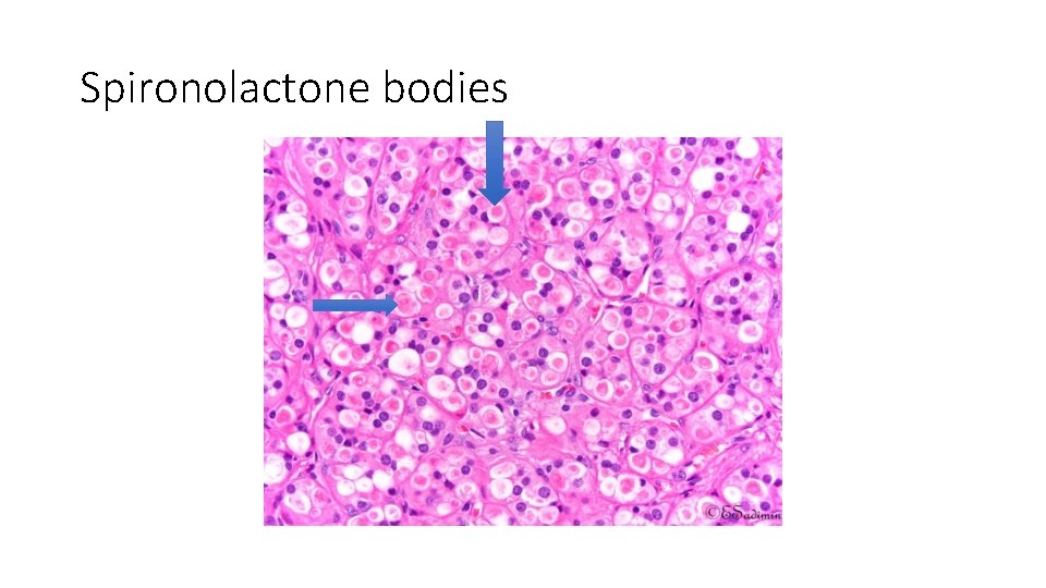 Spironolactone bodies 