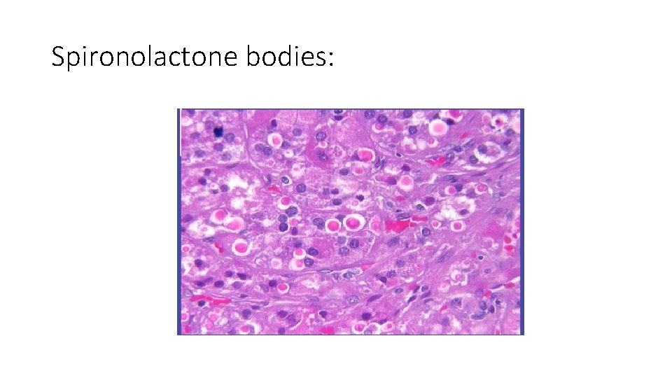 Spironolactone bodies: 