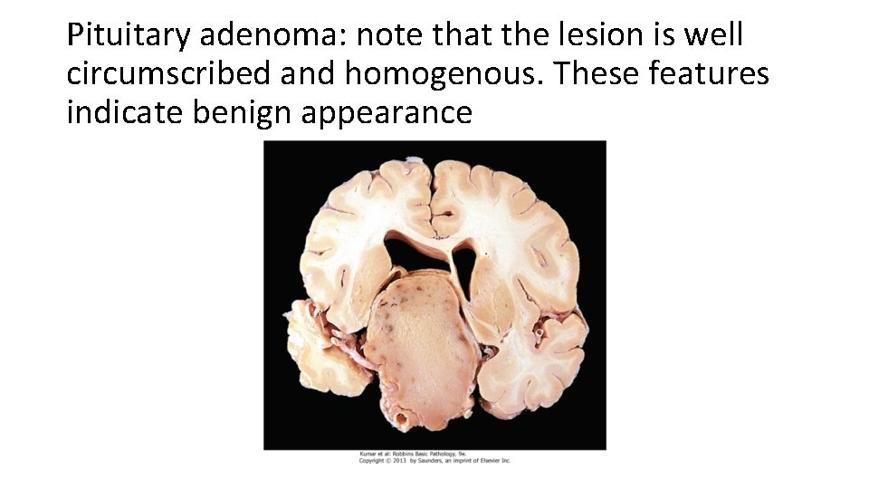 Pituitary adenoma: note that the lesion is well circumscribed and homogenous. These features indicate