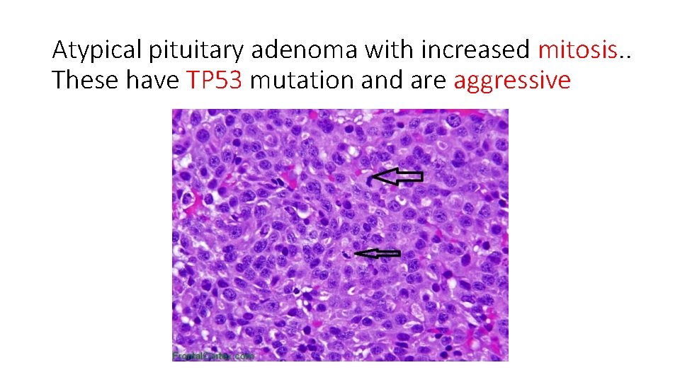 Atypical pituitary adenoma with increased mitosis. . These have TP 53 mutation and are