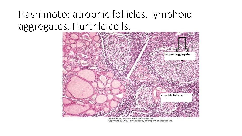Hashimoto: atrophic follicles, lymphoid aggregates, Hurthle cells. 