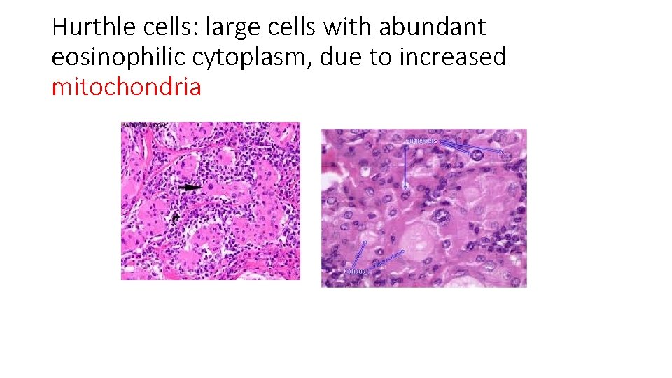 Hurthle cells: large cells with abundant eosinophilic cytoplasm, due to increased mitochondria 