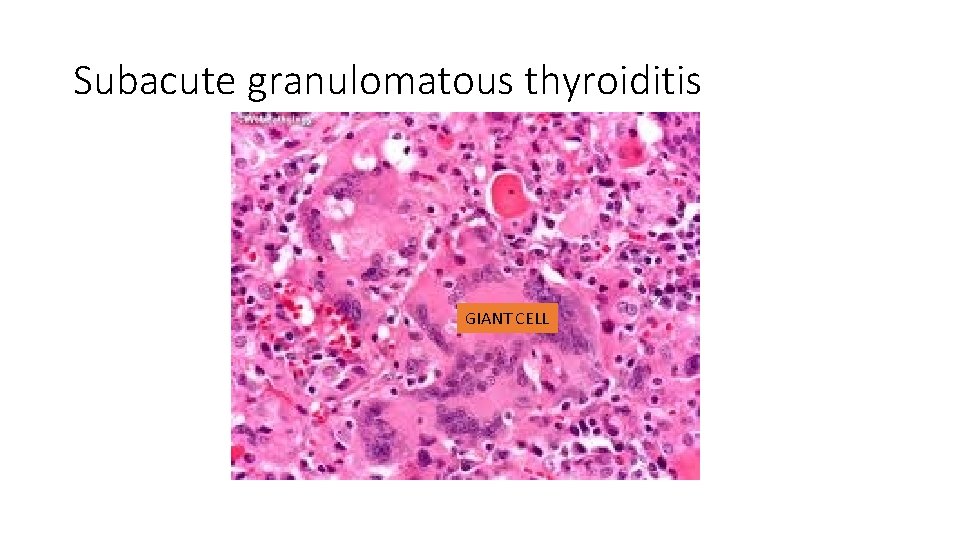 Subacute granulomatous thyroiditis GIANT CELL 