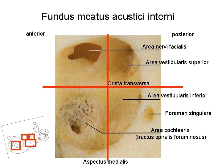 Fundus meatus acustici interni anterior posterior Area nervi facialis Area vestibularis superior Crista transversa