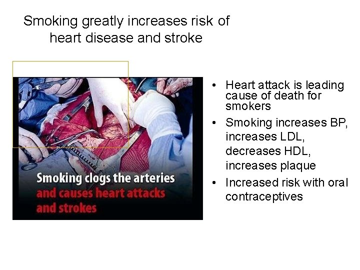 Smoking greatly increases risk of heart disease and stroke • Heart attack is leading
