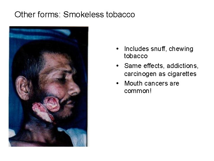 Other forms: Smokeless tobacco • • Includes snuff, chewing tobacco • Same effects, addictions,