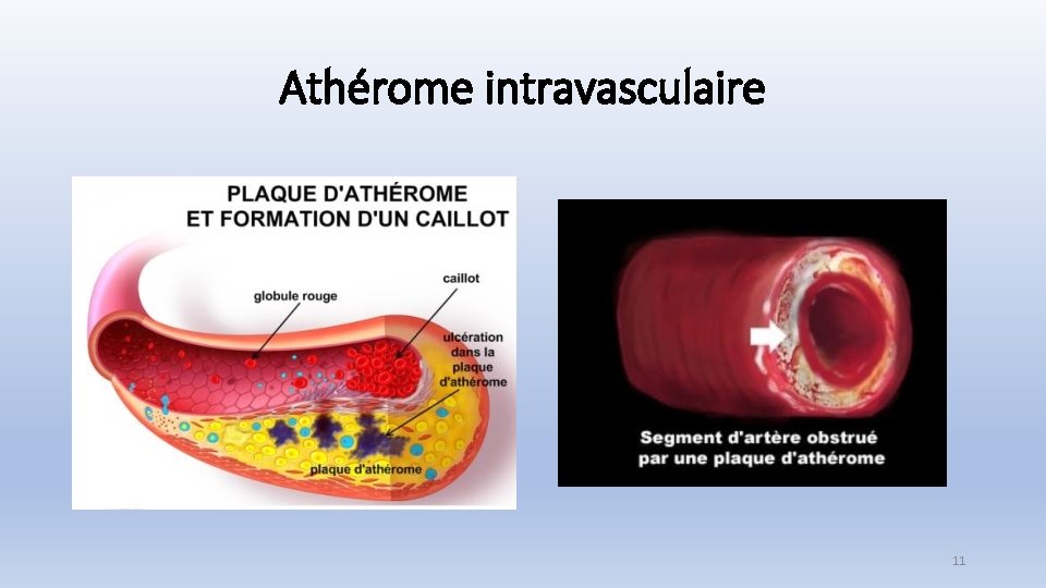 Athérome intravasculaire 11 