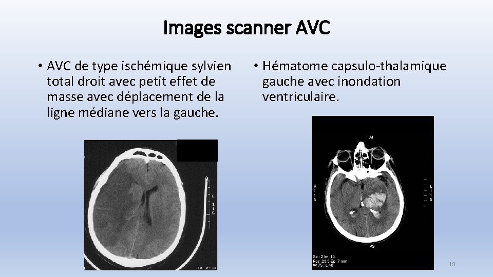 Images scanner AVC • AVC de type ischémique sylvien total droit avec petit effet