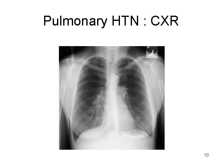 Pulmonary HTN : CXR 10 