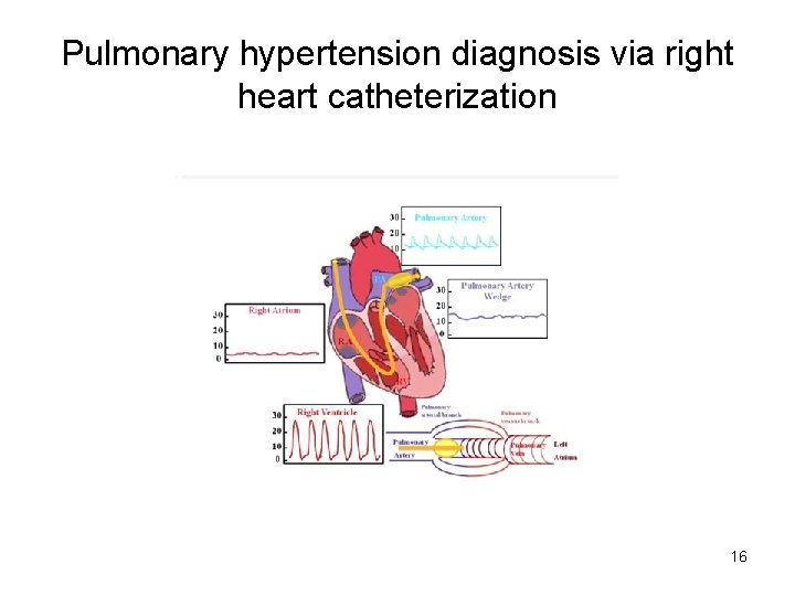 Pulmonary hypertension diagnosis via right heart catheterization 16 