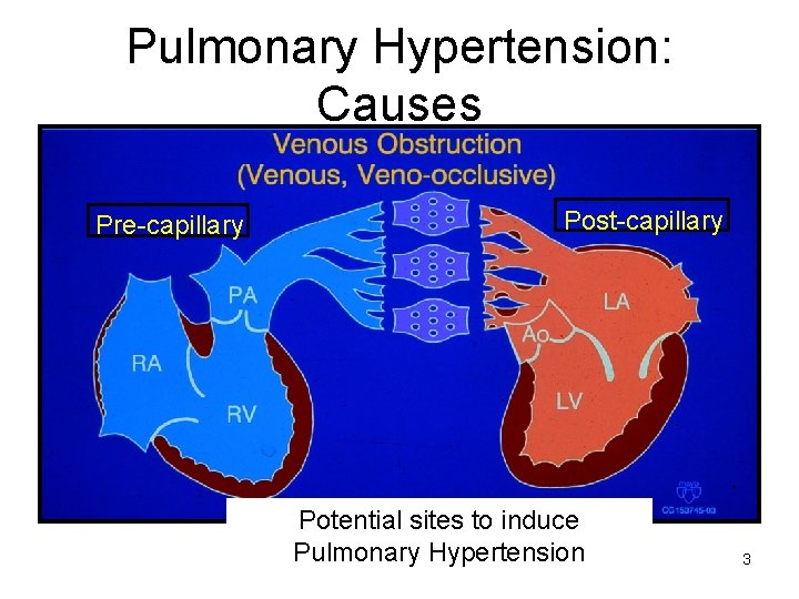 Pulmonary Hypertension: Causes Pre-capillary Post-capillary Potential sites to induce Pulmonary Hypertension 3 