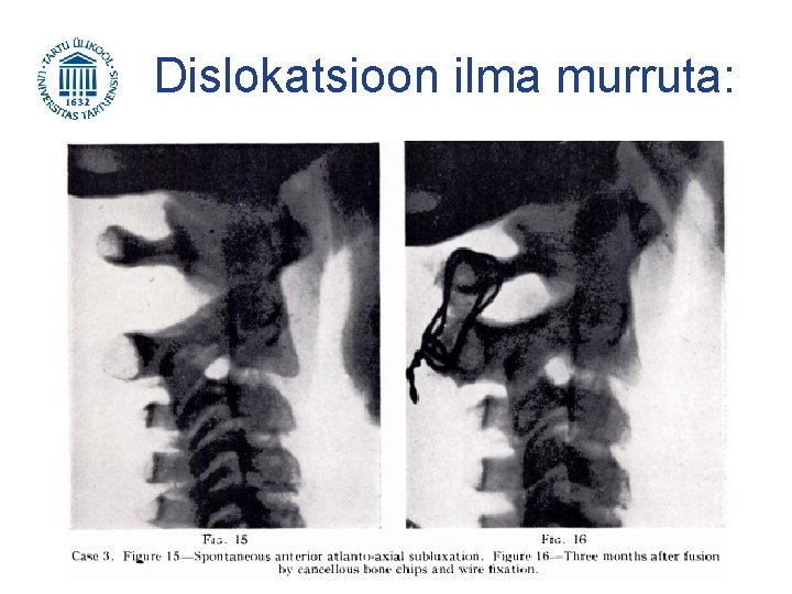 Dislokatsioon ilma murruta: 