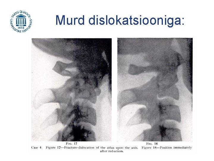 Murd dislokatsiooniga: 