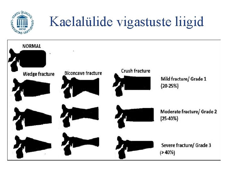 Kaelalülide vigastuste liigid Kaelalülide murrud painutamisest (pea liigub ettepoole): • lihtsad kiilutaolised murrud •