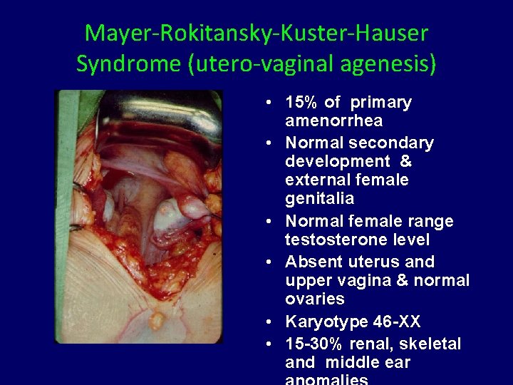Mayer-Rokitansky-Kuster-Hauser Syndrome (utero-vaginal agenesis) • 15% of primary amenorrhea • Normal secondary development &