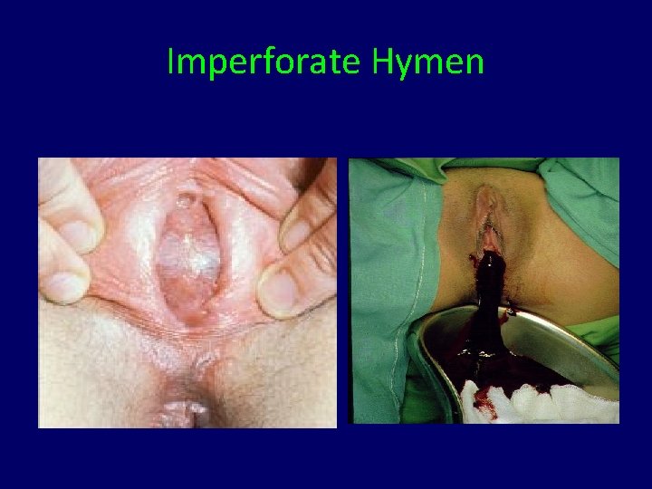 Imperforate Hymen 