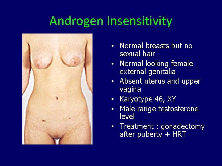 Androgen Insensitivity • Normal breasts but no sexual hair • Normal looking female external