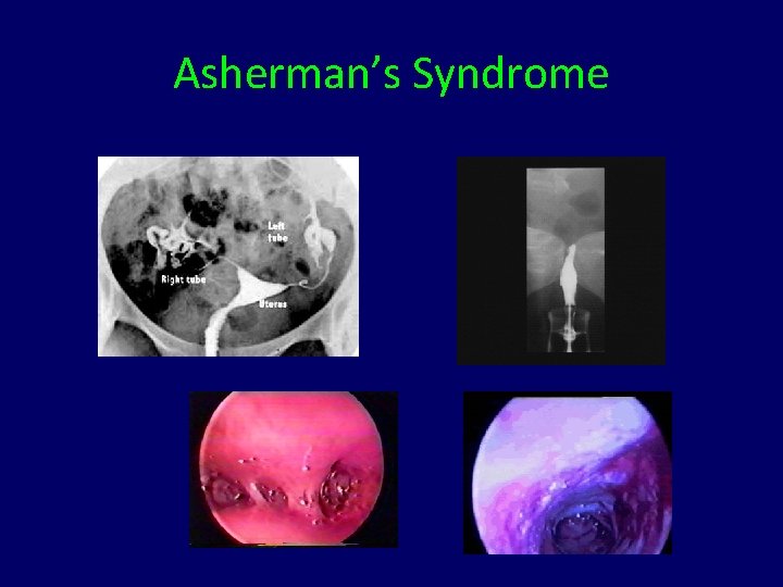 Asherman’s Syndrome 