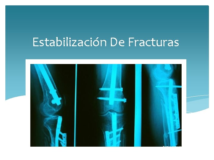 Estabilización De Fracturas 