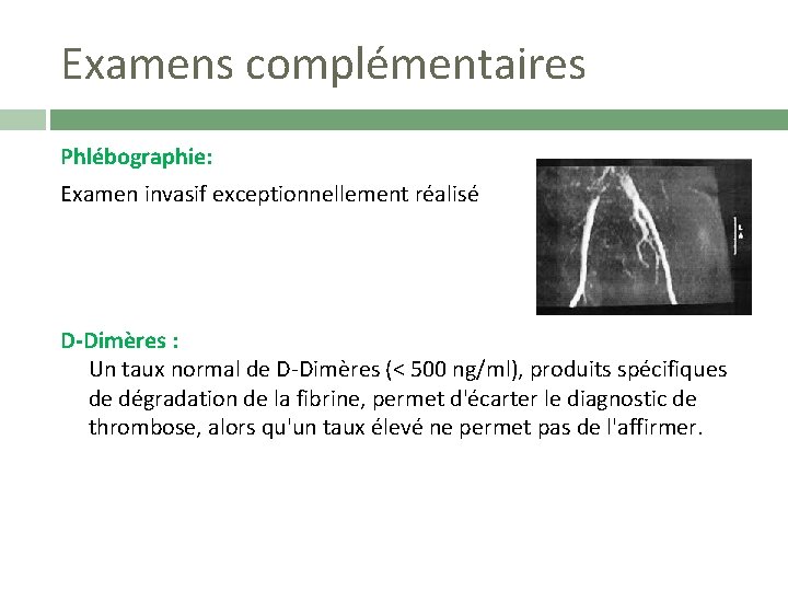 Examens complémentaires Phlébographie: Examen invasif exceptionnellement réalisé D-Dimères : Un taux normal de D-Dimères