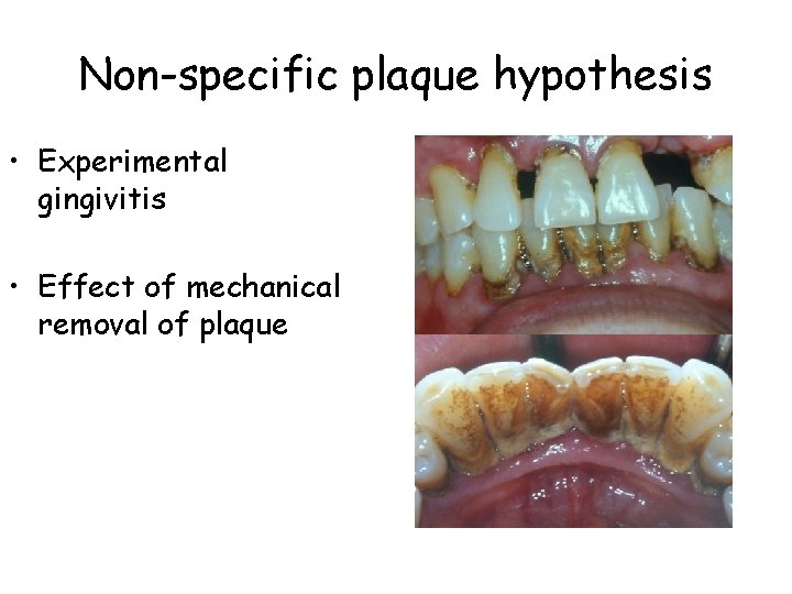 Non-specific plaque hypothesis • Experimental gingivitis • Effect of mechanical removal of plaque 