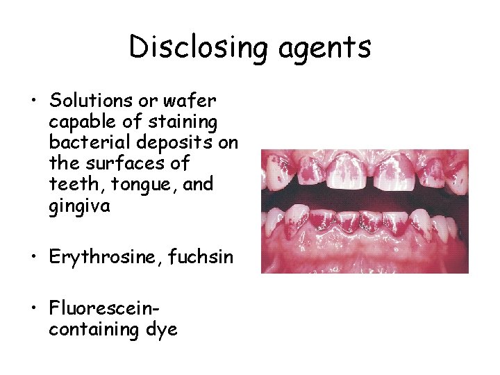 Disclosing agents • Solutions or wafer capable of staining bacterial deposits on the surfaces