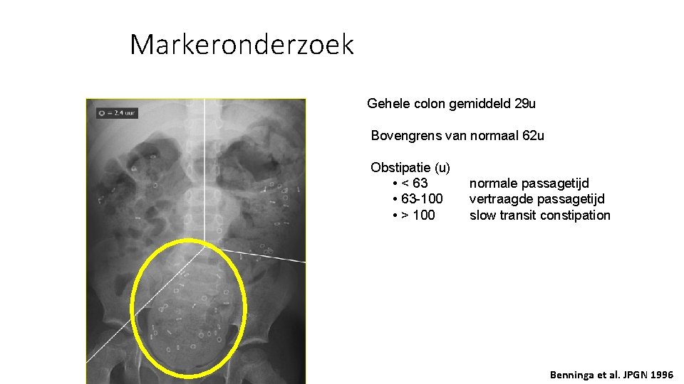 Markeronderzoek Gehele colon gemiddeld 29 u Bovengrens van normaal 62 u Obstipatie (u) •