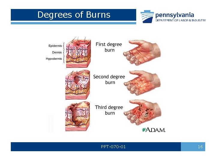 Degrees of Burns PPT-070 -01 16 Degrees of Burns PPT-070 -01 16