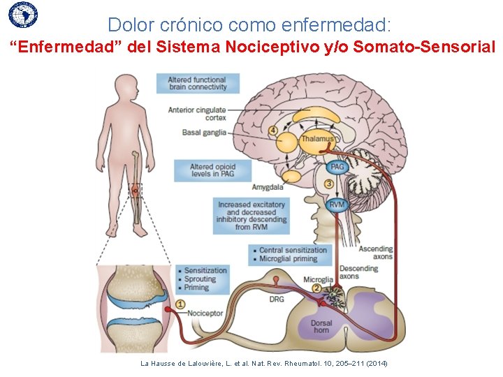 Dolor crónico como enfermedad: “Enfermedad” del Sistema Nociceptivo y/o Somato-Sensorial La Hausse de Lalouvière,