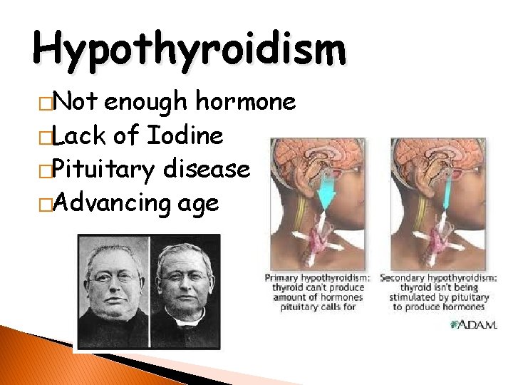 Hypothyroidism �Not enough hormone �Lack of Iodine �Pituitary disease �Advancing age 