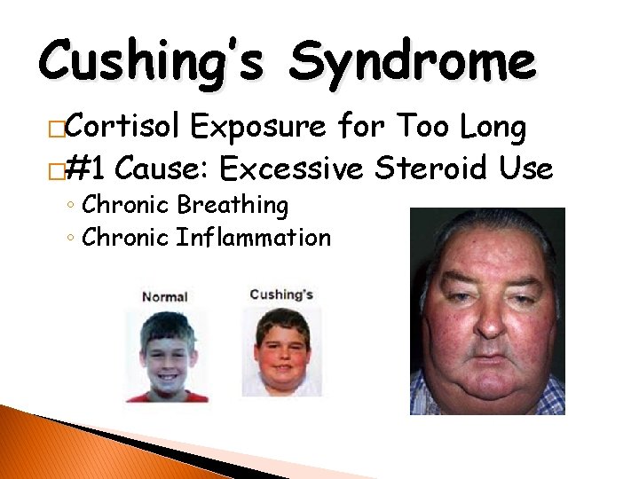 Cushing’s Syndrome �Cortisol Exposure for Too Long �#1 Cause: Excessive Steroid Use ◦ Chronic