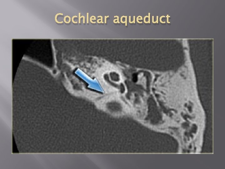 Cochlear aqueduct 