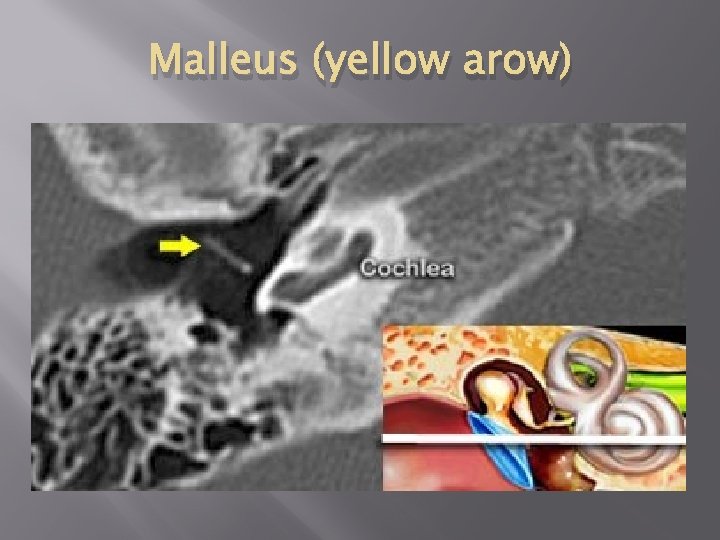Malleus (yellow arow) 