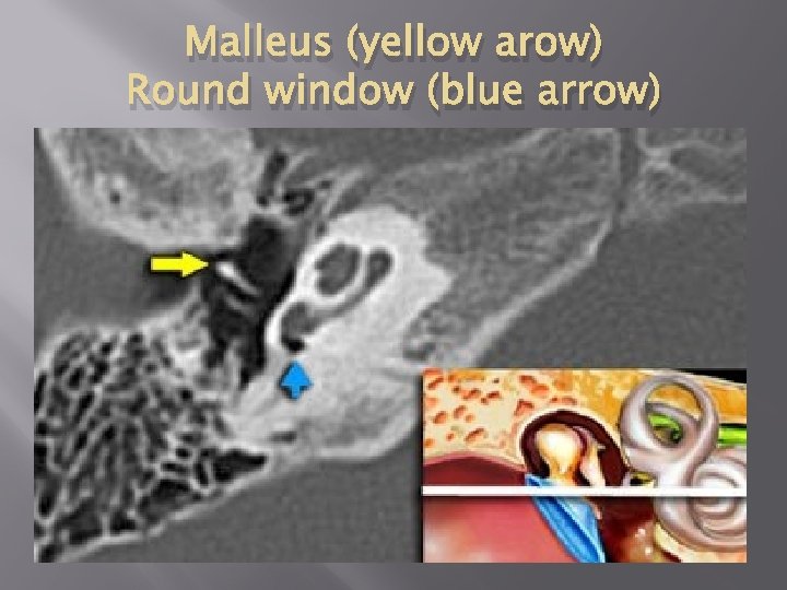Malleus (yellow arow) Round window (blue arrow) 
