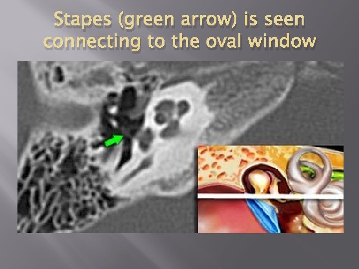 Stapes (green arrow) is seen connecting to the oval window 