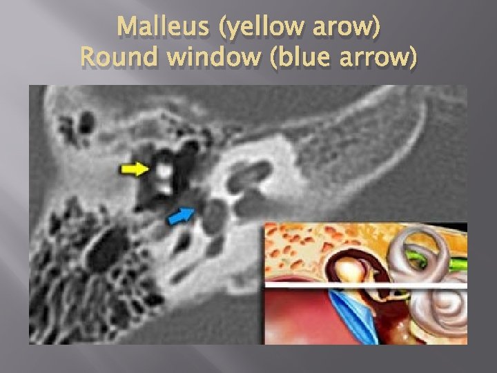 Malleus (yellow arow) Round window (blue arrow) 