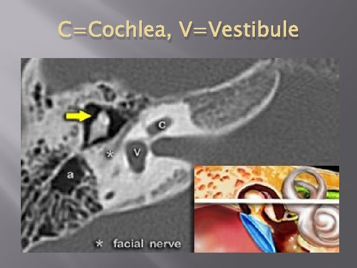 C=Cochlea, V=Vestibule 
