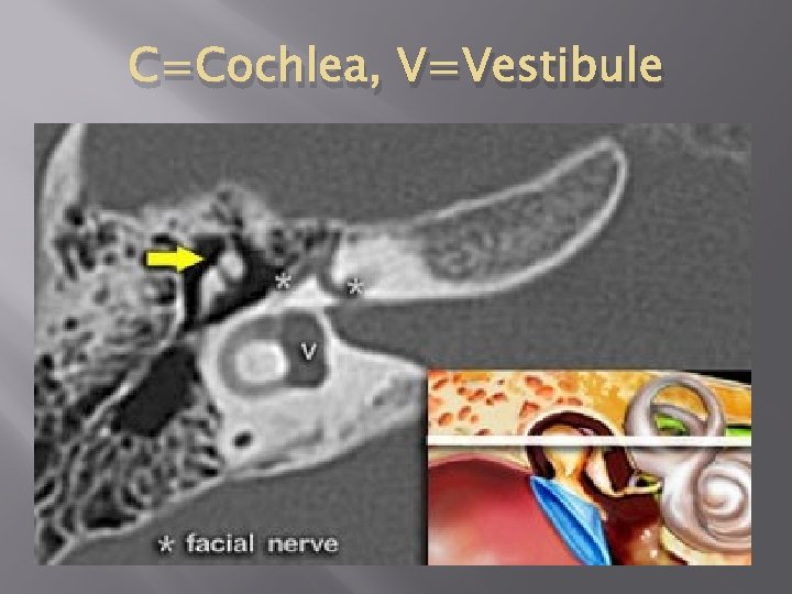 C=Cochlea, V=Vestibule 