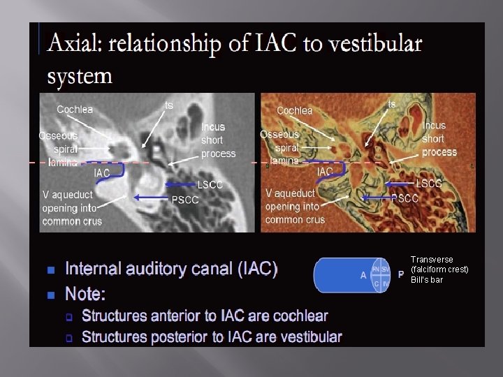 Transverse (falciform crest) Bill’s bar 