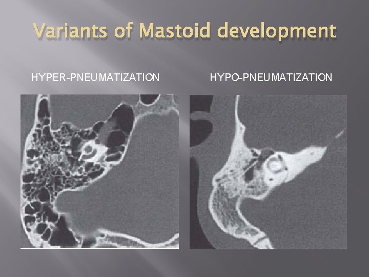 Variants of Mastoid development HYPER-PNEUMATIZATION HYPO-PNEUMATIZATION 
