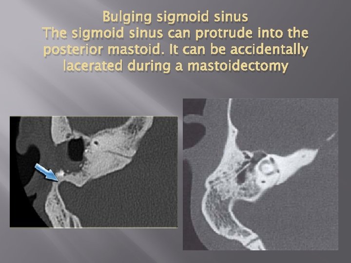 Bulging sigmoid sinus The sigmoid sinus can protrude into the posterior mastoid. It can