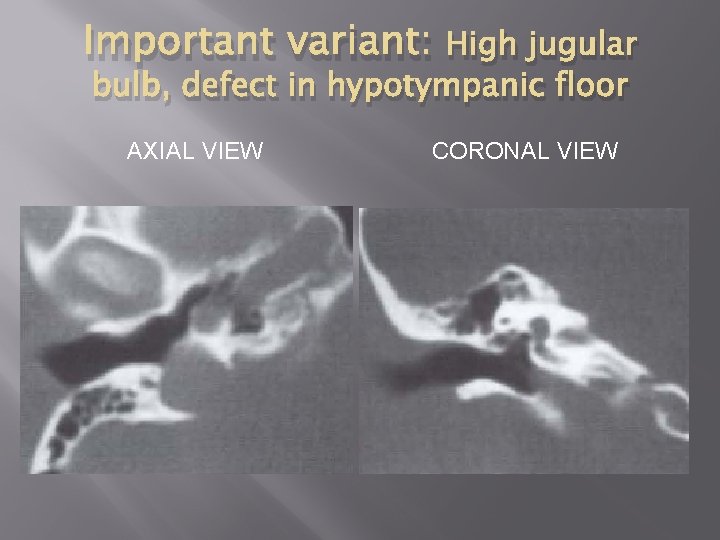 Important variant: High jugular bulb, defect in hypotympanic floor AXIAL VIEW CORONAL VIEW 