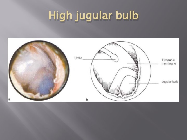 High jugular bulb 